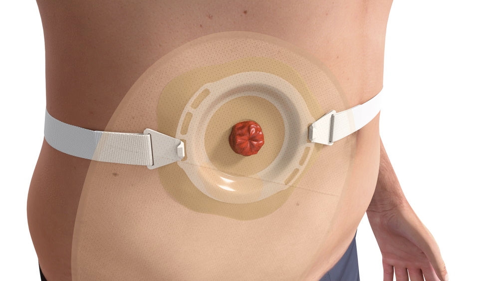 Illustration av konvex stomipåse applicerad runt en stomi