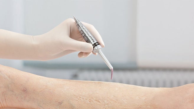 En liten tub Askina Calgitrol paste 15 g appliceras på ett patients ben av en handskbeklädd hand