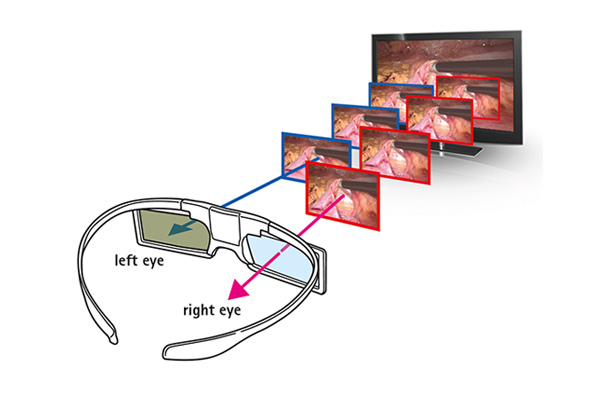 3D Teknologi inom laparoskopi