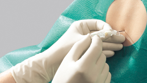 Kombinerad spinal och epiduralanestesi
