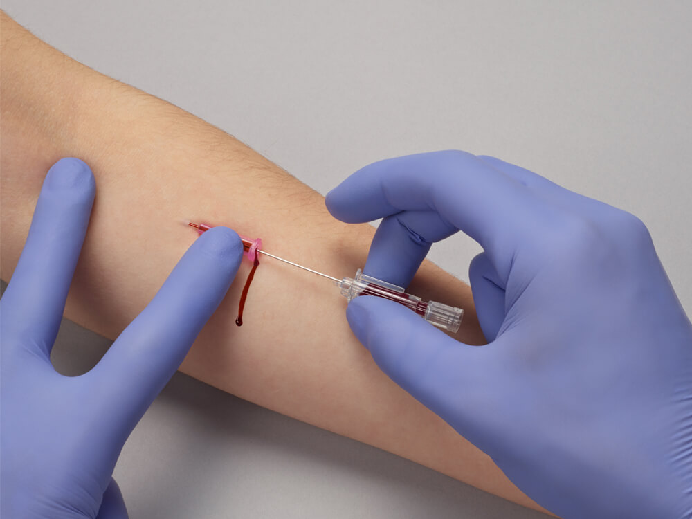 En sjukvårdsanställd med blå handskar tar försiktigt blod från en patients arm med hjälp av en spruta