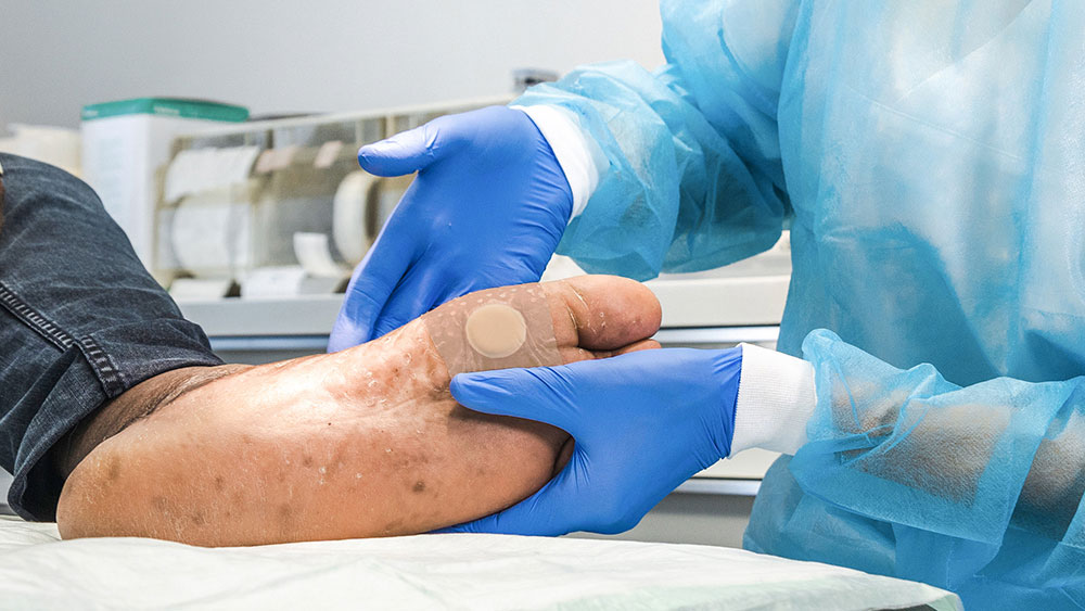 Två händer med handskar håller en diabetisk fot med ett plåster på, i bakgrunden medicinskt material i ett läkarrum