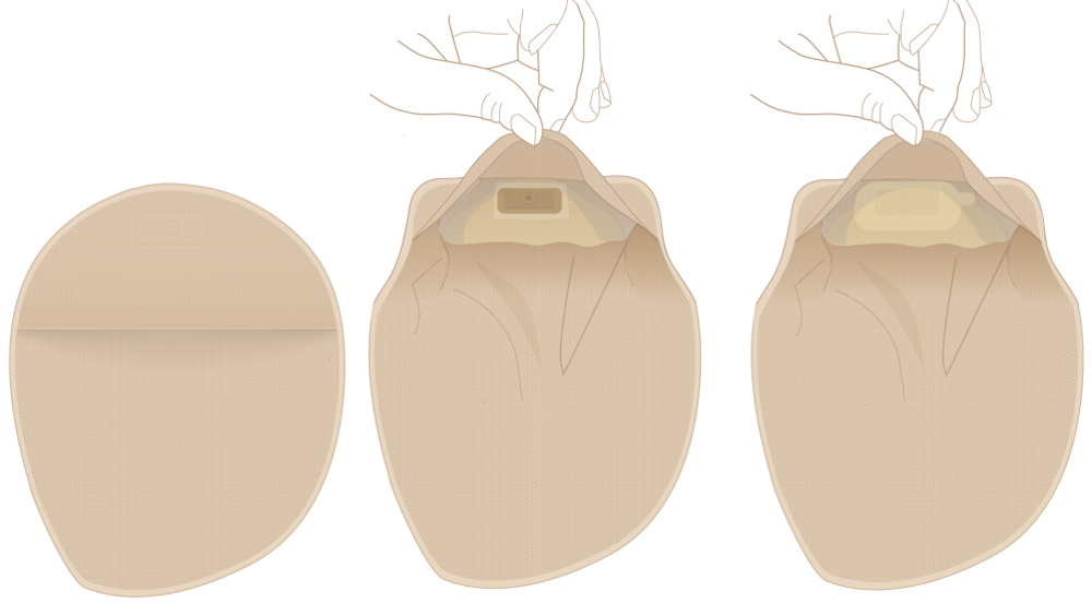 En hand täcker filtret på en stomipåse